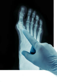 Hallux Rigidus – Ursachen, Symptome und Behandlungsmöglichkeiten